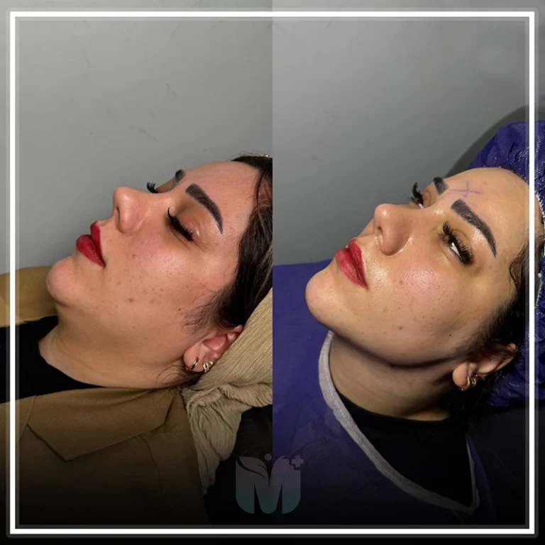 نمونه عکس قبل و بعد از لیپوساکشن غبغب در کلینیک مهرزاد