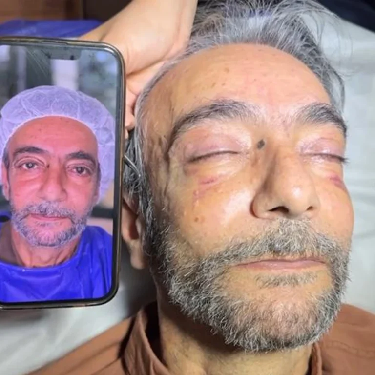 عکس نمونه بلفاروپلاستی کلینیک مهرزاد