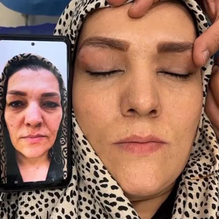 عکس نمونه بلفاروپلاستی کلینیک مهرزاد